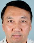 After Hair Transplant &nbsp;Front